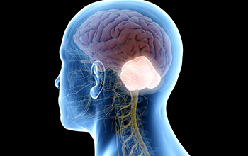 Beyincik Sarkması Chiari Malformasyonu