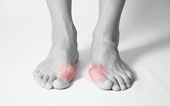 Halluks Valgus