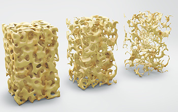 Osteoporoz ve Omurganın Osteoporotik Kırıkları