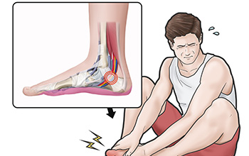 Tarsal Tünel Sendromu