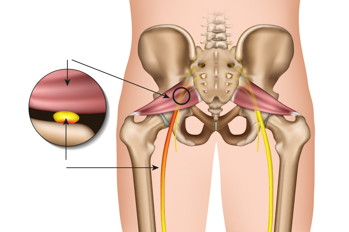 Piriformis Enjeksiyonu Piriformis Enjeksiyonu