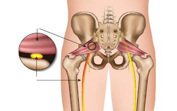 Piriformis Enjeksiyonu Piriformis Enjeksiyonu
