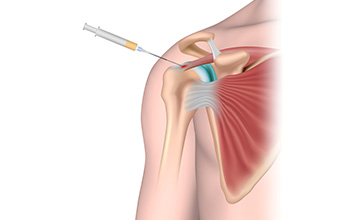 PRP (Platelet Rich Plasma) Tedavisi PRP (Platelet Rich Plasma) Tedavisi