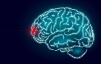 Beyin Cerrahisinde Lazer Kullanımı