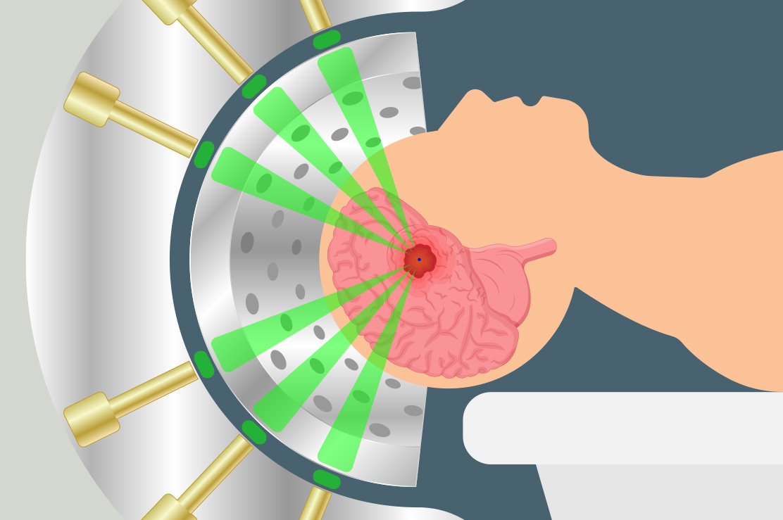 Gamma Knife, Stereotaksik Radyocerrahi