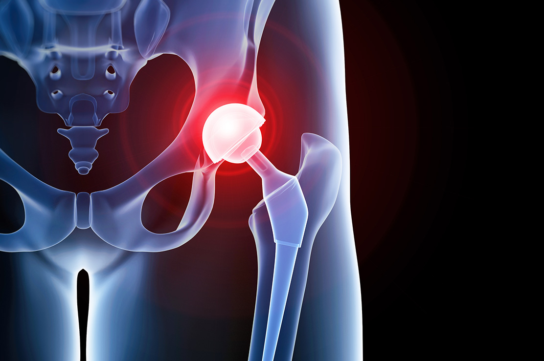 Kalça Protezinde Rehabilitasyon Kalça Protezinde Rehabilitasyon