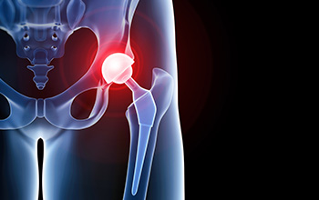Kalça Protezinde Rehabilitasyon Kalça Protezinde Rehabilitasyon