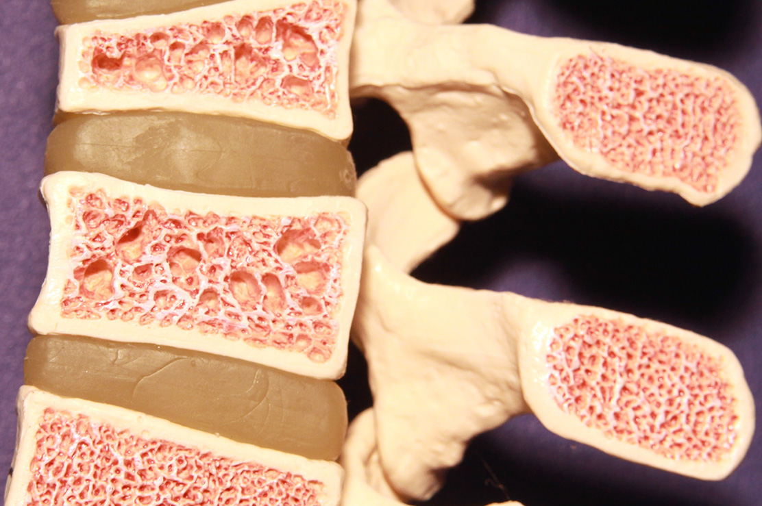 Vertebroplasti ve Kifoplasti Vertebroplasti ve Kifoplasti
