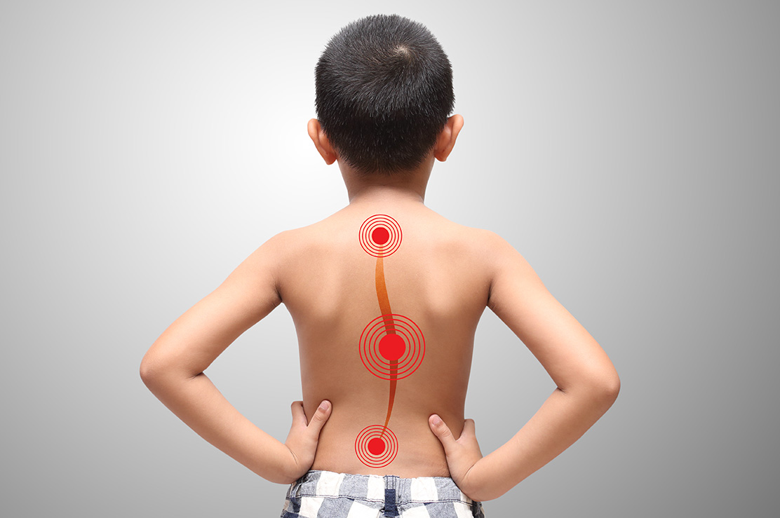 Vertebroplasti ve Kifoplasti Vertebroplasti ve Kifoplasti