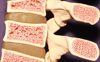 Vertebroplasti ve Kifoplasti Vertebroplasti ve Kifoplasti
